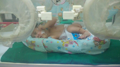 Bayi Laki Laki di Inhil Lahir Dengan Usus di Luar