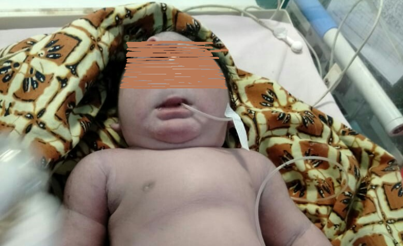 Bayi Mata Satu Tanpa Hidung, Meninggal Dunia di RSUD Siak