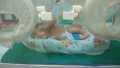 Bayi Laki Laki di Inhil Lahir Dengan Usus di Luar